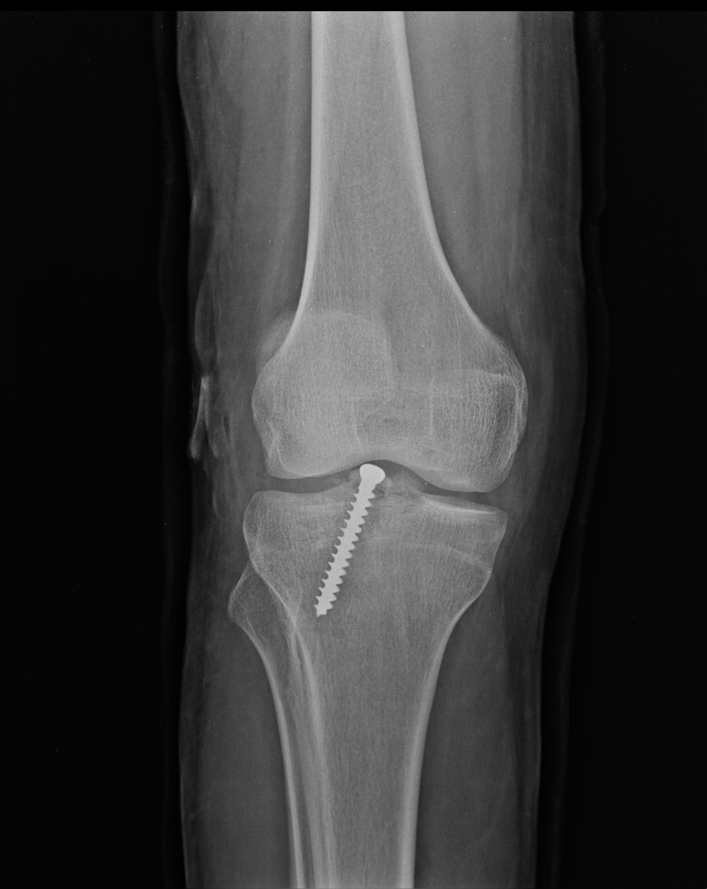 Anterior cruciate ligament bony avulsion | Image | Radiopaedia.org