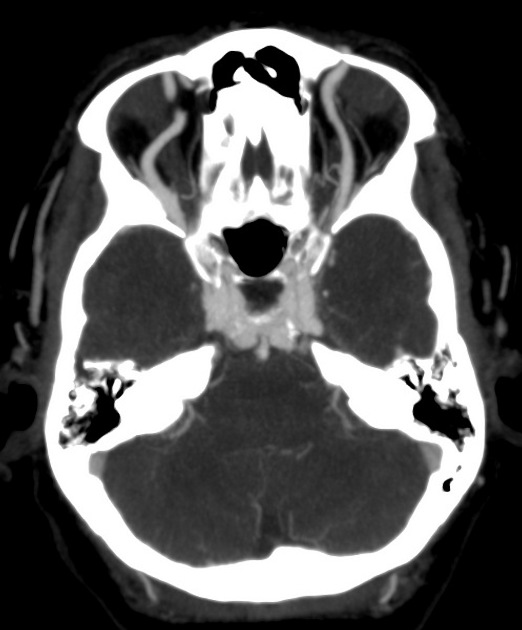 Caroticocavernous fistula Radiology Reference Article