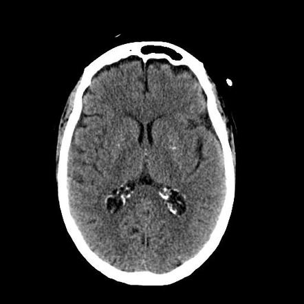 Traumatic rupture of transverse colon, small bowel injury and Hangman's ...