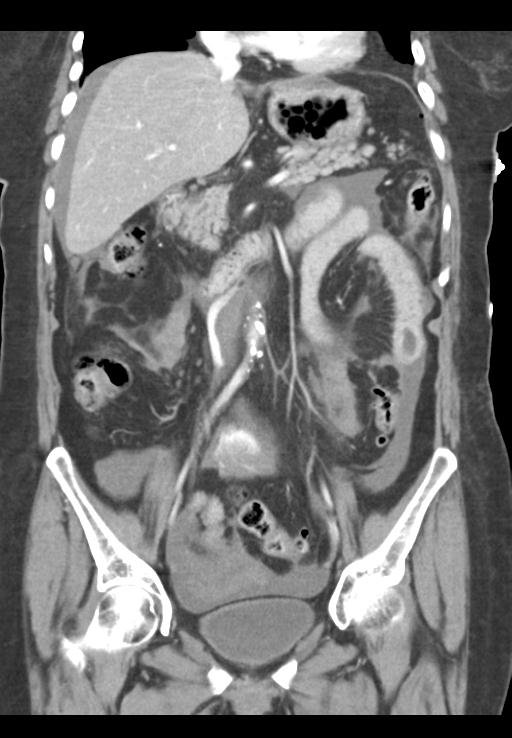 Traumatic rupture of transverse colon, small bowel injury and Hangman's ...