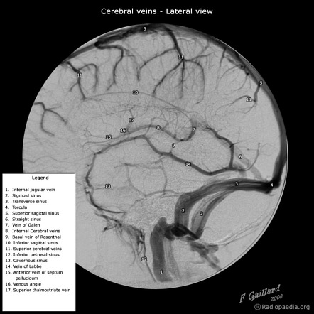 Superficial veins of the brain | Radiology Reference Article ...