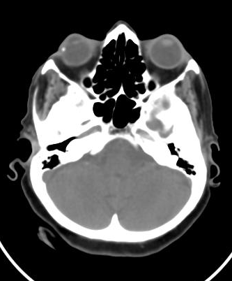 Senile calcific scleral plaques | Image | Radiopaedia.org