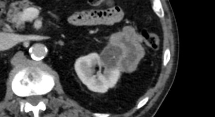 Sarcomatoid Renal Cell Carcinoma Radiology Reference Article Radiopaedia Org