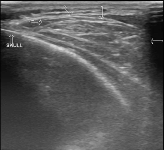 Lipoma Scalp Image 1355