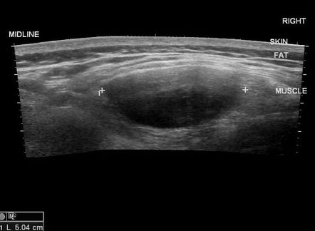 Fibromatosis - dorsolumbar region | Image | Radiopaedia.org