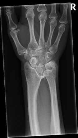 Madelung deformity | Radiology Reference Article | Radiopaedia.org