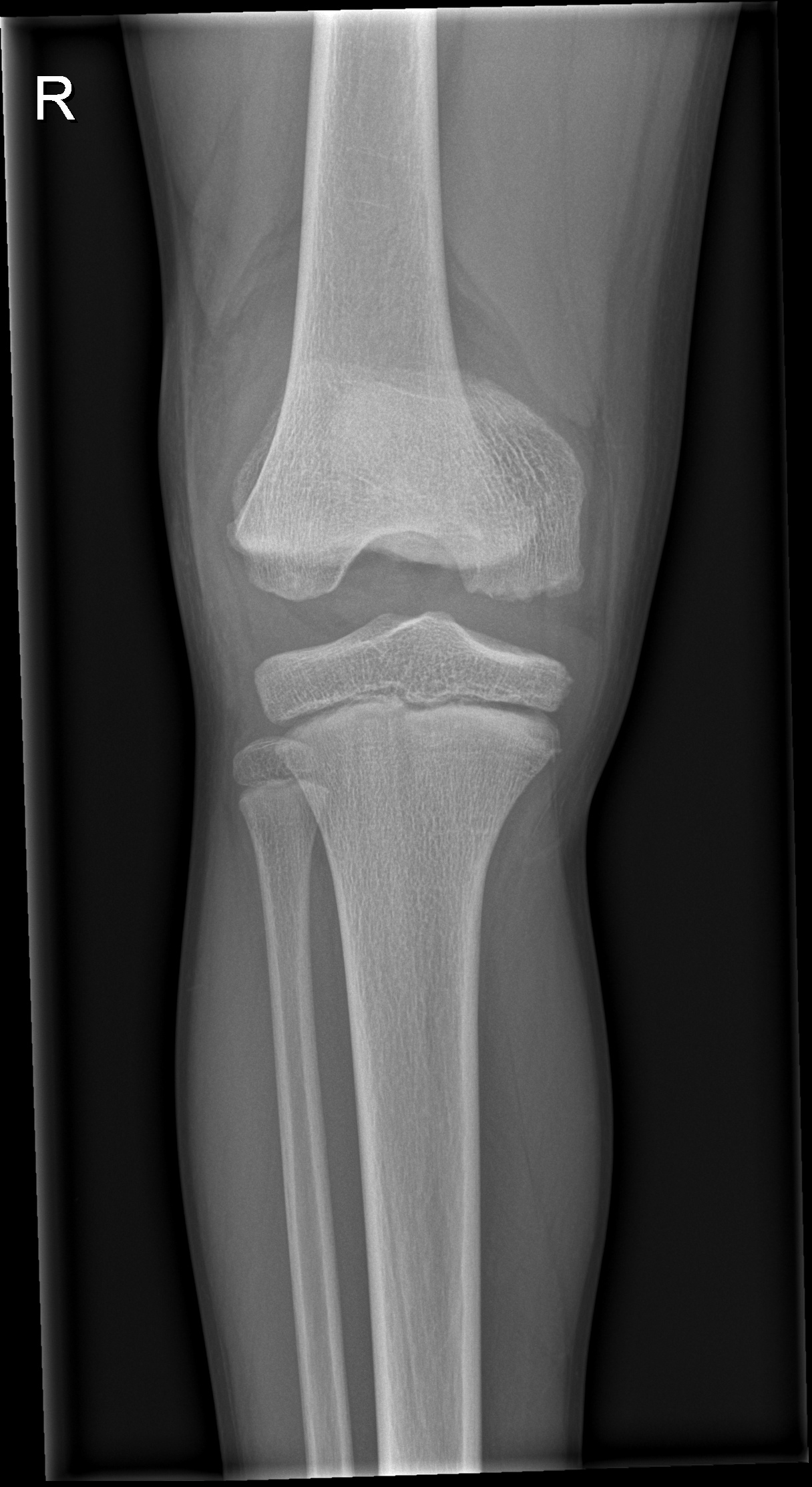 Epiphysiolysis of distal femoral epiphysis | Image | Radiopaedia.org