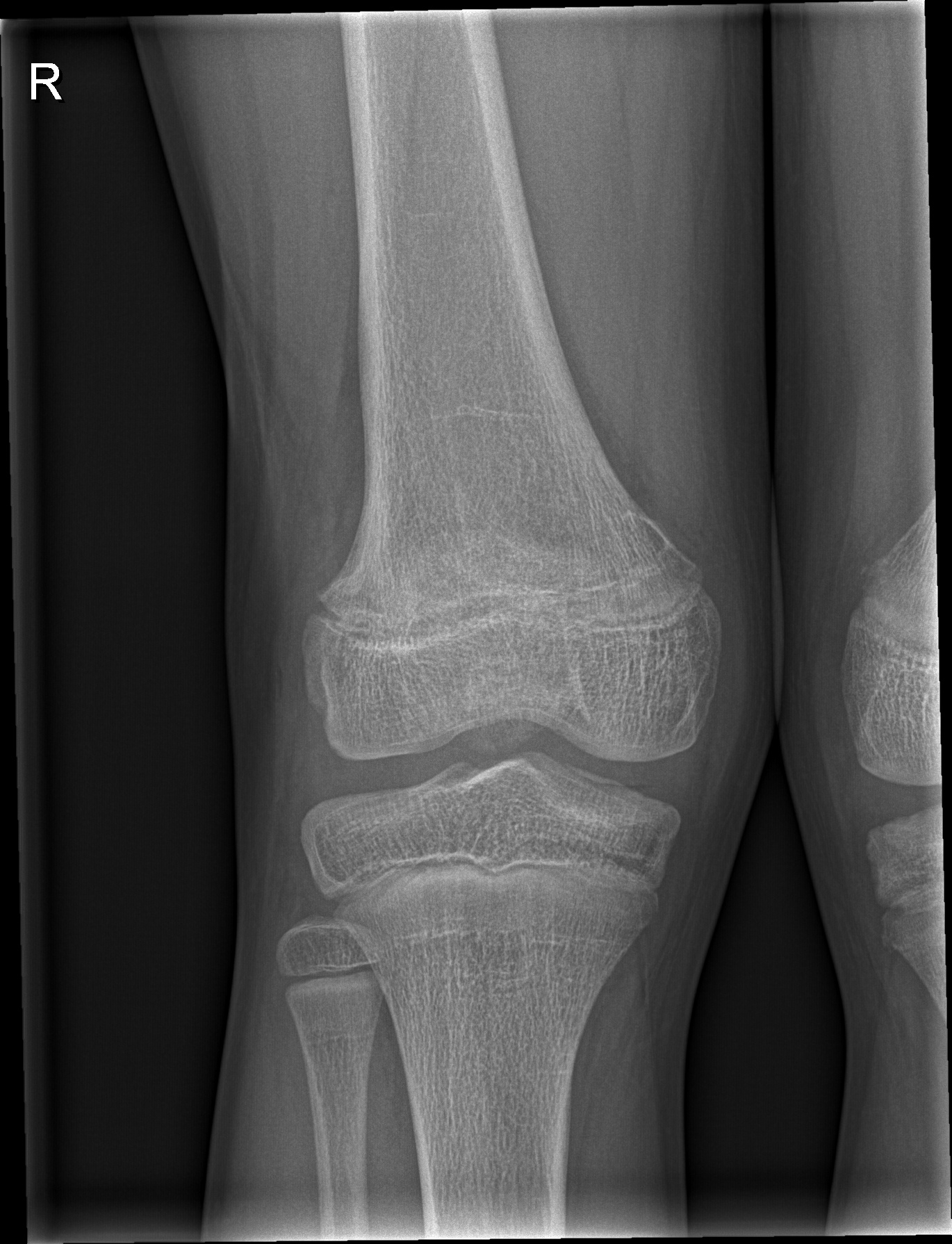 Epiphysiolysis of distal femoral epiphysis | Image | Radiopaedia.org