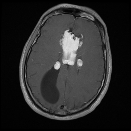 Pericallosal lipoma - tubulonodular | Radiology Case | Radiopaedia.org