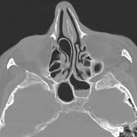 Deviated nasal septum | Radiology Reference Article | Radiopaedia.org