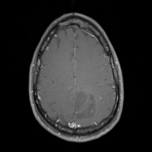 Oligodendroglioma NOS | Image | Radiopaedia.org