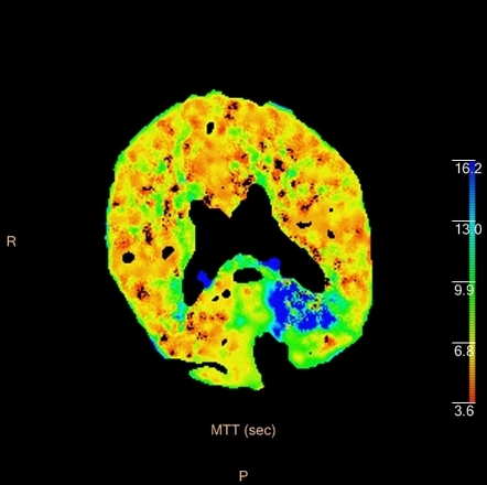 Ct Perfusion - Occipital Core Infarct 