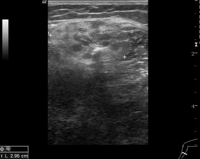 Slow flow venous malformation | Image | Radiopaedia.org