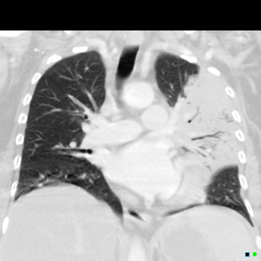 Lobar Pneumonia Histology