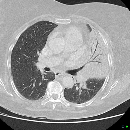 case study lobar pneumonia