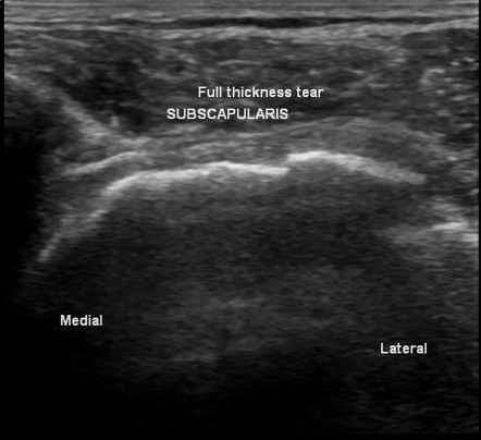 Subscapularis tendon tear | Radiology Case | Radiopaedia.org