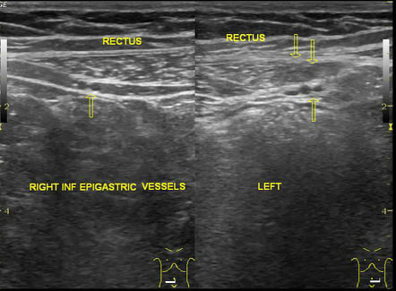 Rectus abdominis muscle strain | Radiology Case | Radiopaedia.org