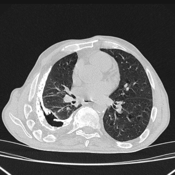 Fibrothorax | Image | Radiopaedia.org