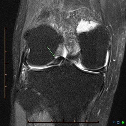 Flipped lateral meniscus | Image | Radiopaedia.org