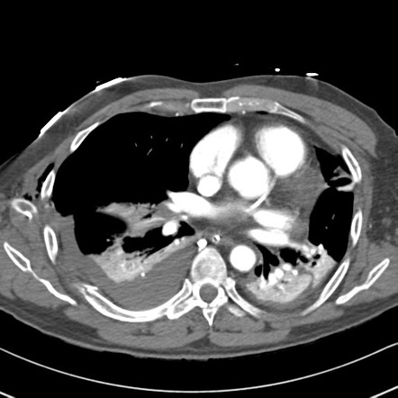 Pneumocath in pulmonary artery and left atrium | Image | Radiopaedia.org