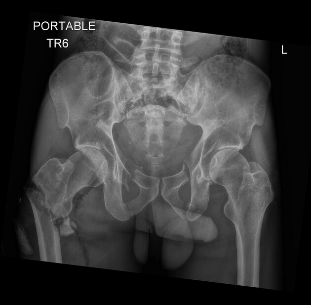 Types of Pelvis Fractures