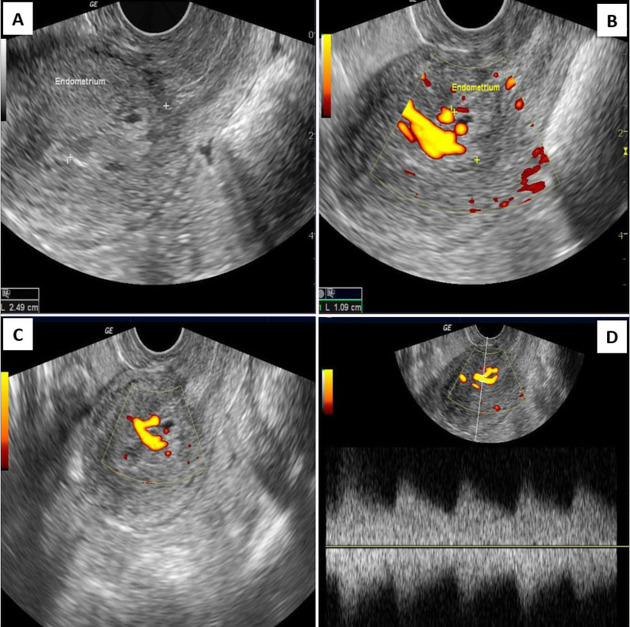 Uterine Cancer Ultrasound Images