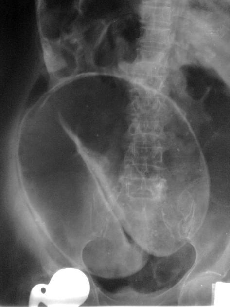 Coffee Bean Sign Sigmoid Colon Radiology Reference Article Radiopaedia Org