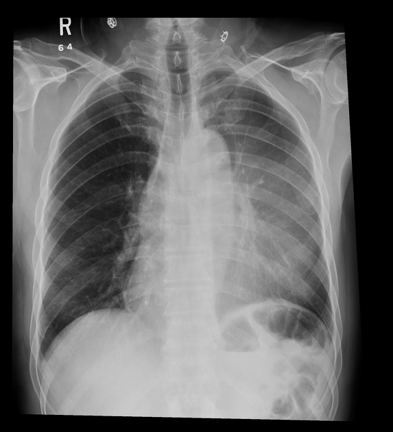 atelectasis chest x ray