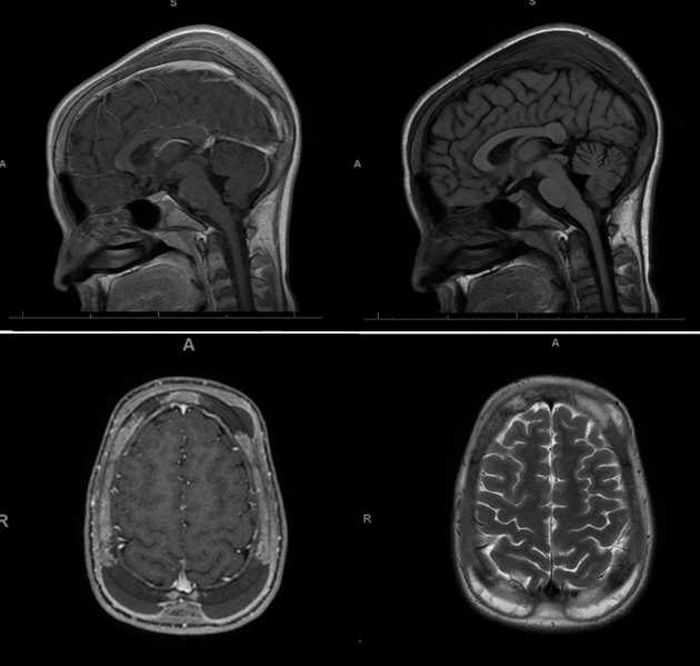 Venous vascular territories of the lateral cerebral cortex (illustration), Radiology Case