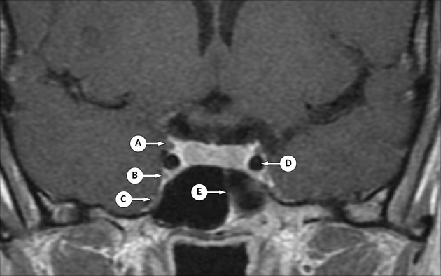 Cavernous Sinus Radiology Reference Article Radiopaedia Org