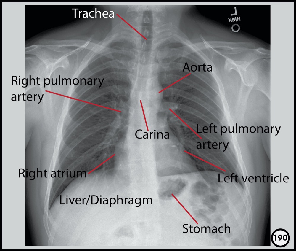 Chest X-ray: Graphic Novel | Radiopaedia.org