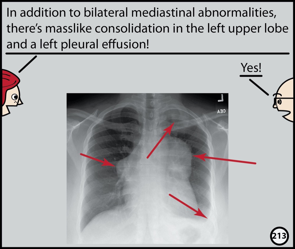 Chest X-ray: Graphic Novel | Radiopaedia.org