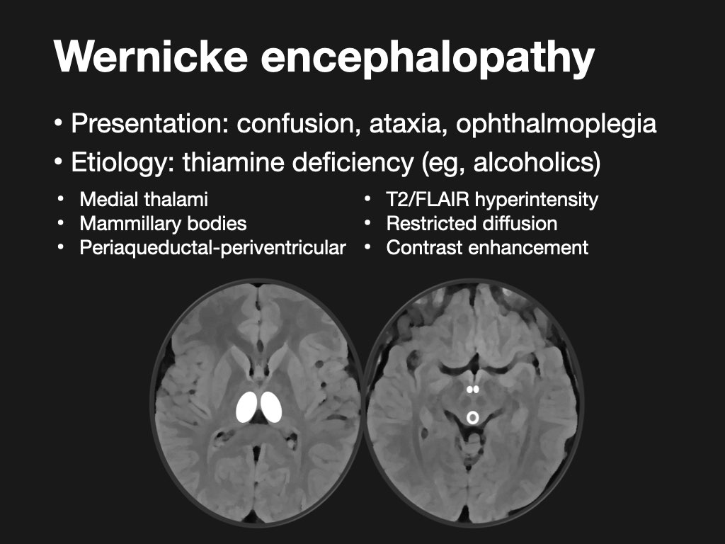 Toxic & Metabolic Brain Disorders in Adults | Radiopaedia.org