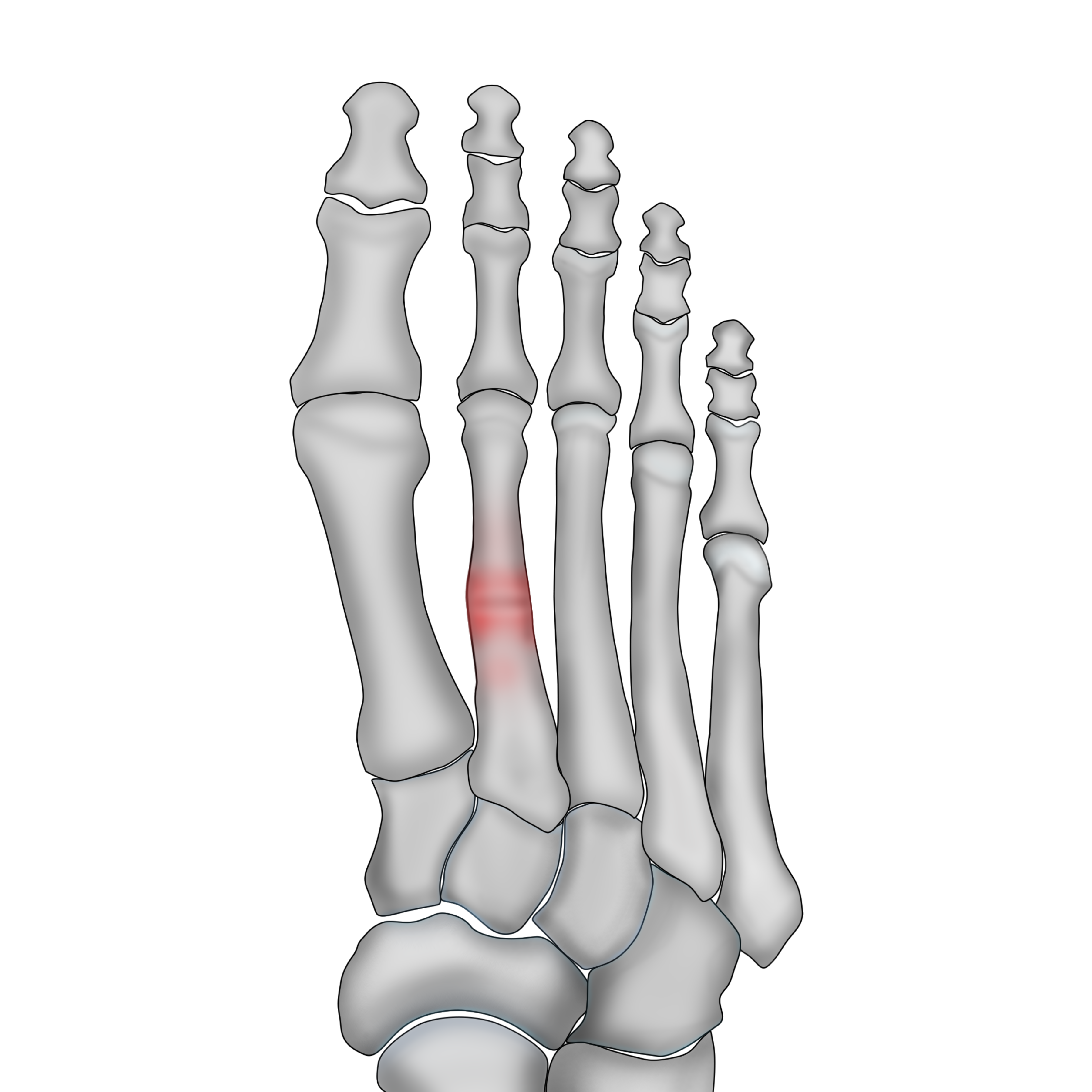 X-ray Interpretation: Foot and Ankle Injuries | Radiopaedia.org