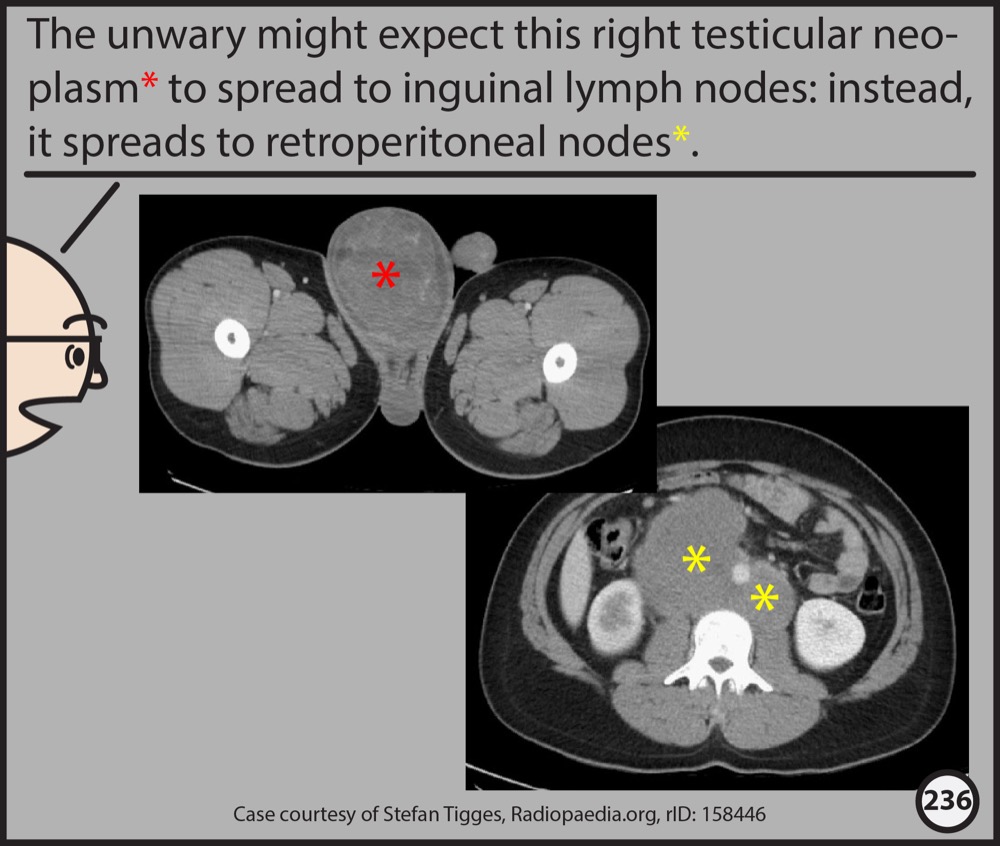 Abdominopelvic CT: The Graphic Novel | Radiopaedia.org