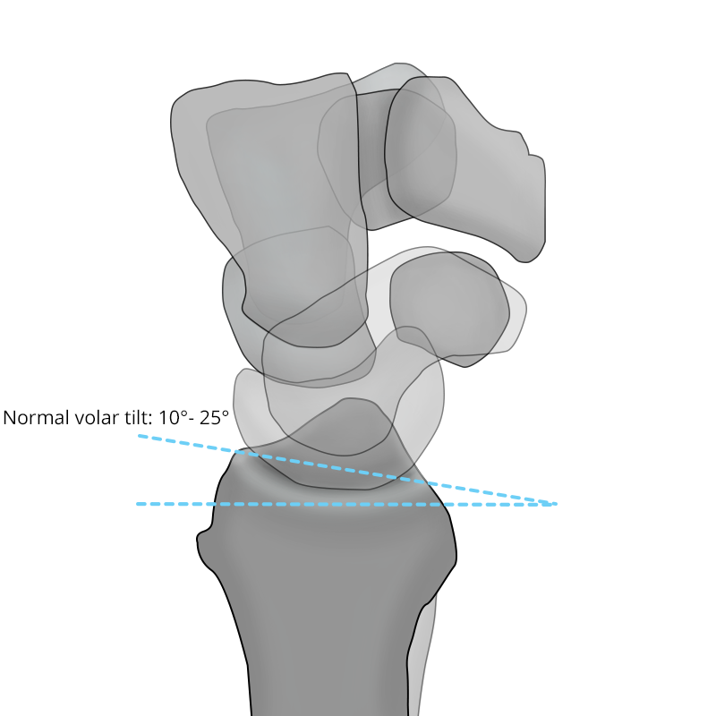 What Is Volar Tilt at Steven Weber blog