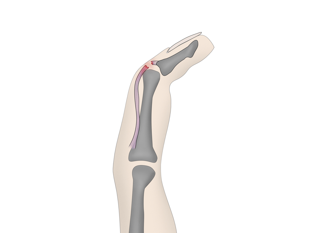 X-ray Interpretation: Hand Injuries | Radiopaedia.org