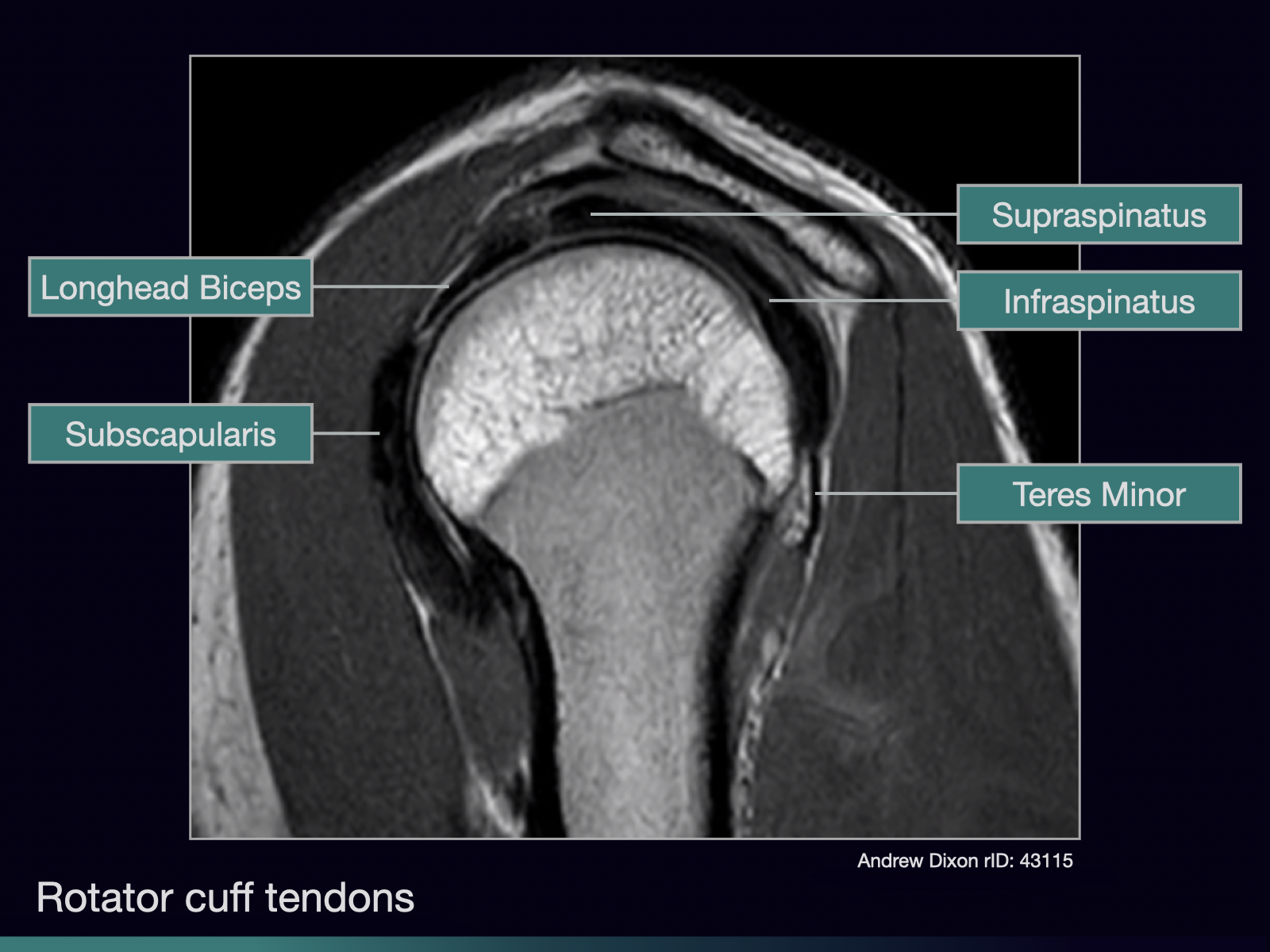 Radiology Quiz 129746 | Radiopaedia.orgPlaylist 'Approach to shoulder ...