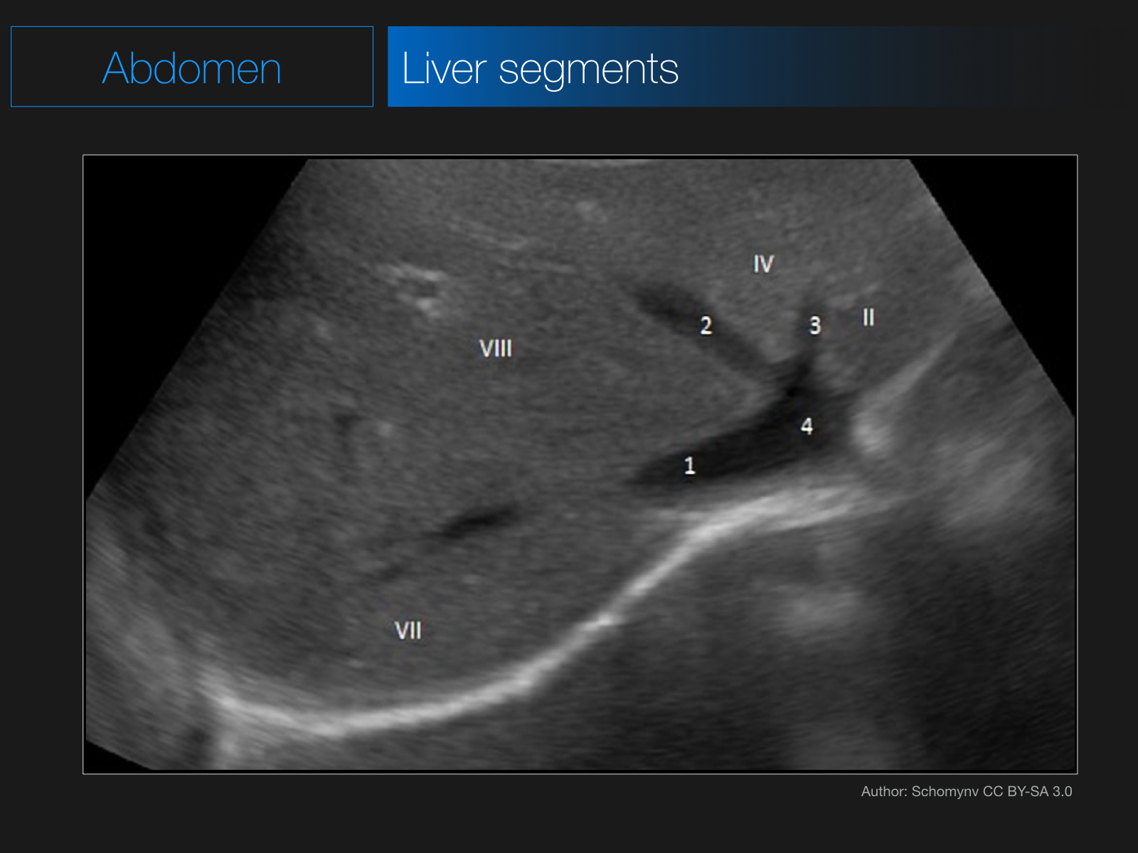 Узи печени схема. Сегменты печени на УЗИ Изранов. Ультразвуковая анатомия печени сегменты. 4 Сегмент печени на УЗИ. 1 Сегмент печени на УЗИ.