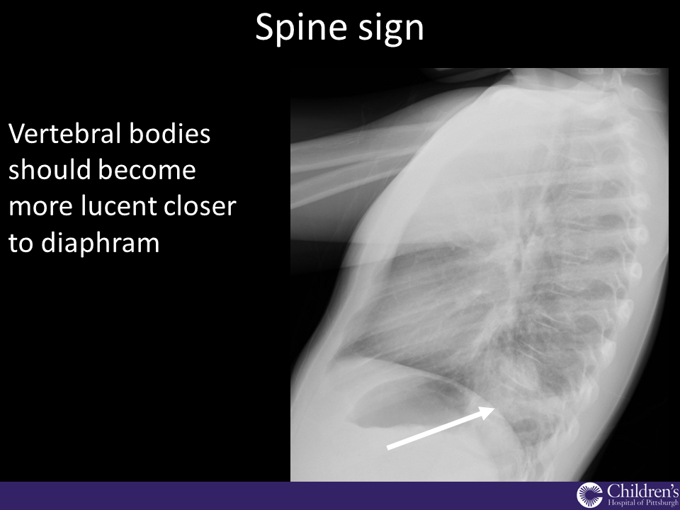 Radiology Quiz 61481 | Radiopaedia.org | Playlist 'Pediatric Radiology ...