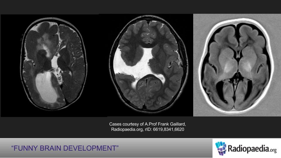 Radiology Quiz 77078 | Radiopaedia.org | Playlist 'Epilepsy Imaging DCN ...