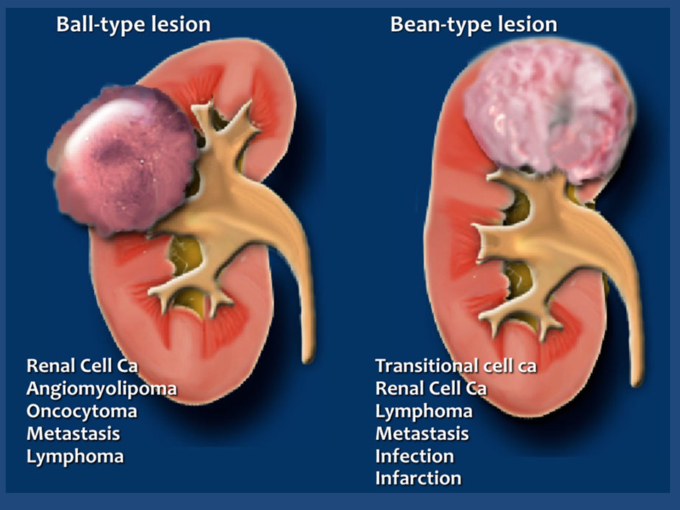 Что такое образование почки. Доброкачественные образования почек. Объемное образование почки.