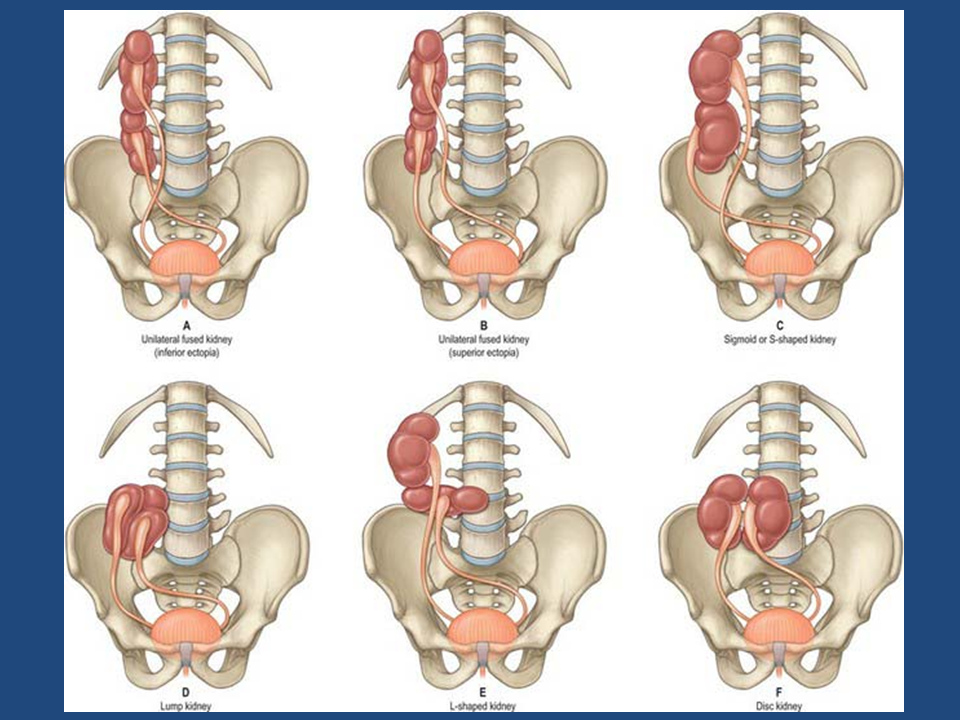 Нарушения развития почек. Аномалия расположения почек ротация. Дистопия (эктопия) почек. Аномалии развития почек дистопия.